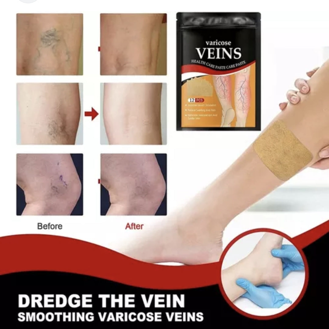 Parche Varices